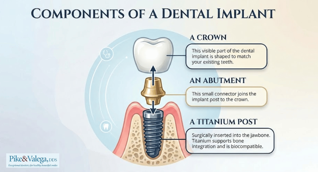 dental-implant-components-infographic Components of a dental implant.
