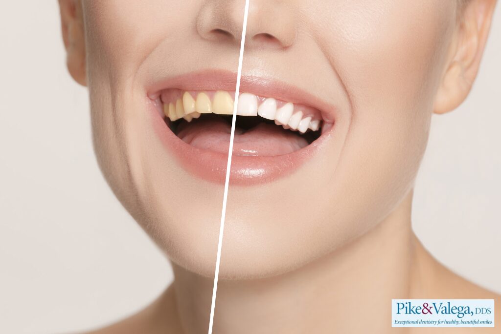 Before and after teeth whitening showing a woman’s bright smile