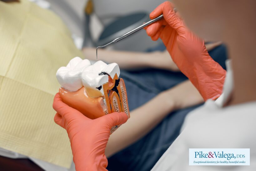 Dentist holding a tooth model showing cavity damage that requires root canal treatment
